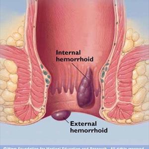 Hemorrhoid Cream Uses - Hemorrhoids Treatment And Diagnosis