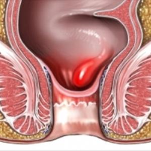 Hemorrhoids Treatment Home Remedy - About Urinary Tract Infection - Prevention And Treatments