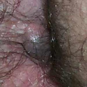 How To Treat Hemorrhoids Naturally - Internal And External Hemorrhoids