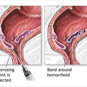 Hemroid Pain - How To Use Food To Get Hemorrhoid Relief