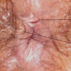 Diet For Hemorrhoids - Can You Really Treat Hemorrhoids With Home Remedies