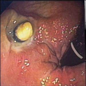 Hemroids - Hemroids Symptoms