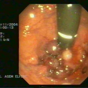 Hemorrhoids Symptoms - Hemorrhoids