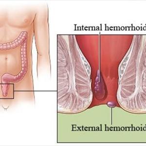Bleeding Internal Hemroid - Easy Ways To Stop Hemorrhoids