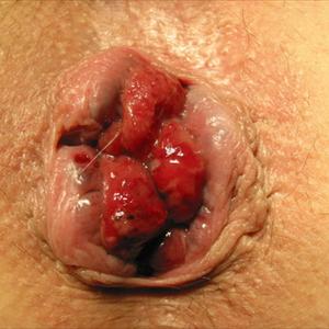 How Long Do Hemroids Bleed - Easing Piles Or Hemorrhoids Naturally