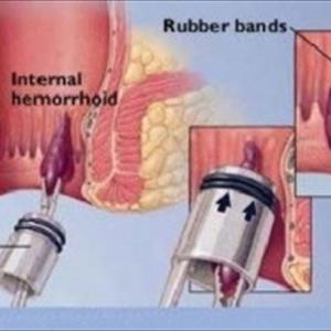 Hemorrhoid Banding - Learn What Causes Hemorrhoids And What You Can Do To Avoid Them