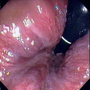 Surgery For Hemroids - Three Steps To Get Rid Of Hemorrhoids