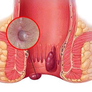 Internal Hemorrhoids Pictures - Some Facts About Hemorrhoids