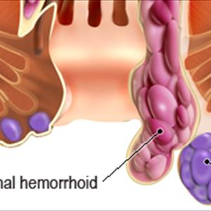 Thrombosed Or Clotted Hemroids - For Instant Hemorrhoid Relief Learn The Latest Tips And Tricks