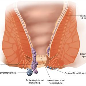 Thrombosed Hemorrhoids - Piles - Home Remedies For Piles