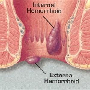 How To Treat Dog Hemroids - Internal Hemorrhoids Symptoms, Cause And Treatment