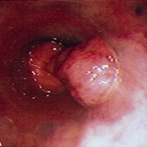 Hemorrhoid Cause - Hemorrhoids Information And Prevention