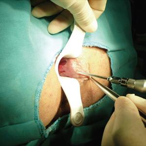 How Long Does A Hemorrhoid Last - How Stop Constipation Stop Hemorrhoids