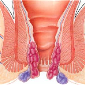 Hemorrhoidal Surgery - Finding A Cure For Hemorrhoids