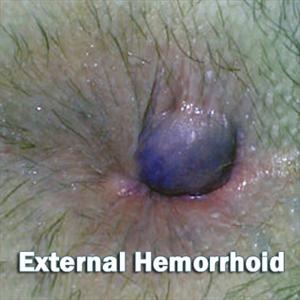 Internal Hemorrhoids Relief - Heartbreaking News About Hemorrhoids