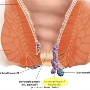 Hemorrhoid Products - Some Of The Most Common Causes Of Hemorrhoids Include Genetics, Constipation And Ruptured Veins