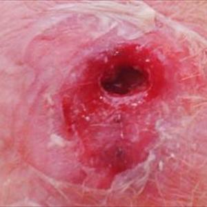 Hemorrhoid Treatment Chicago - Rectal Bleeding As Possible Hemorrhoids Symptom